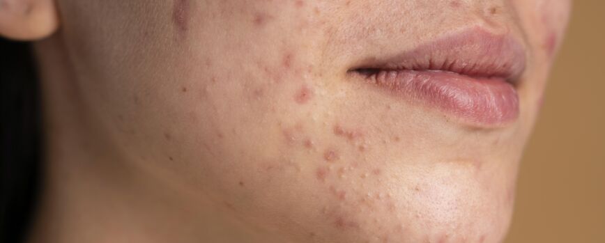 Mulher jovem confiante com close de acne