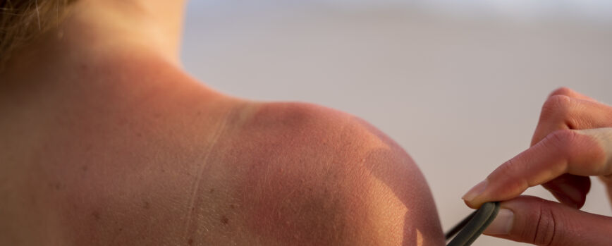 Detalhes da pele queimada pelo sol de uma mulher na praia