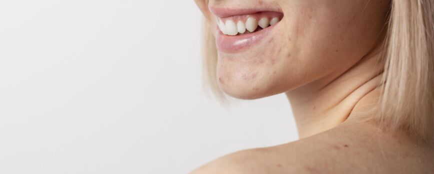 Fechar modelo sorridente com acne