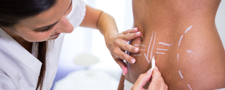 Cirurgião desenhando linhas no abdômen da mulher para lipoaspiração e eliminação da celulite